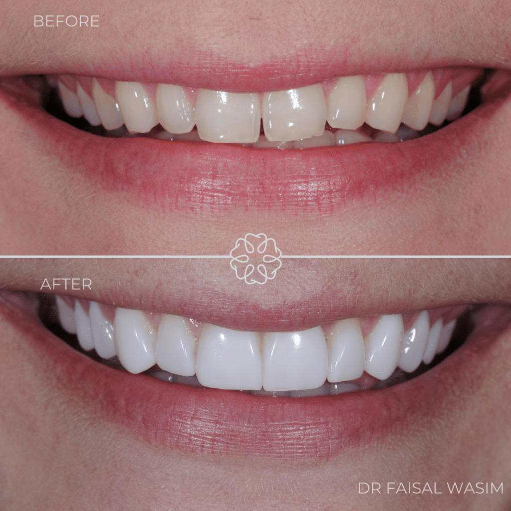Composite bonding before and after